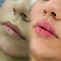 آف ۳۰% ژل بوتاکس بایوفیلر پی ارپی لاغری هایفو لیزر|خدمات آرایشگری و زیبایی|اهواز, کوی باهنر|دیوار