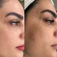 رفع لک صورت رفع چروک گردن فیلر بادی جوانسازی دست