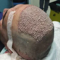 کاشت مو اقساطی باضمانت نامه کتبی مادامالعمر|خدمات آرایشگری و زیبایی|یزد, |دیوار