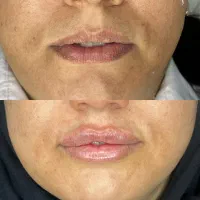 لیزر، ژل،بوتاکس،خال برداری و الکترولیز،لیبیاپلاستی