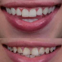 طرح لبخند*بی‌نظیرترین کیفیت*کمترین قیمت دندانپزشکی|خدمات آرایشگری و زیبایی|شیراز, ملاصدرا|دیوار