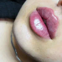 کیلینیک تخصصی زیبایی ژل بوتاکس فیلر لب گونه زاویه