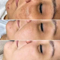 جشنواره ویژه کربن‌تراپی و پیلینگ هالیوودی