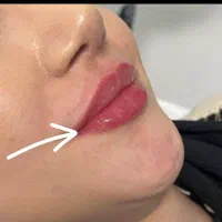 فروش و مدل ژل و بوتاکس|خدمات آرایشگری و زیبایی|اندیکا, |دیوار