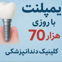 ایمپلنت کره ای اقساطی تنها با روزی ۱۰۰ هزار تومان