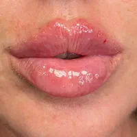 تزریق ژل بوتاکس|خدمات آرایشگری و زیبایی|شیراز, نصرآباد|دیوار