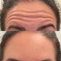 فیلر و بوتاکس