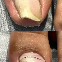 بهبود ناخن های فرو رفته و قارچی بدون جراحی و درد