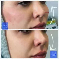 کلینیک تزریق ژل روسی ۳۴۹بوتاکس پروفایلومتدmd/لیزر|خدمات زیبایی و سلامت|تهران, طرشت|دیوار