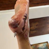 درمان نوین انواع زخم دیابتیک و بستر و جراحی و بخیه|خدمات آرایشگری و زیبایی|صومعهسرا, |دیوار