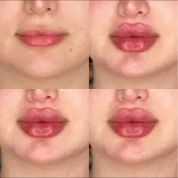 ژل وبوتاکس ولیزر(جشنواره ۵۰ درصدی)