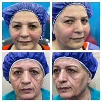 عمل. تزریق چربی صورت بیکینی لابیا پلاستی و بوتاکس|خدمات آرایشگری و زیبایی|رشت, جهاد|دیوار