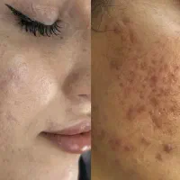 جشنواره عیدانه پوست/ککومک/جای جوش/فشیال/مزونیدلینگ