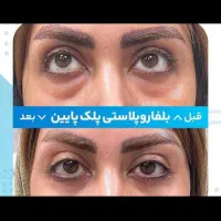 عمل زیبائی پلک پائین شامل پف ، چروک و...|خدمات آرایشگری و زیبایی|اصفهان, خلجا|دیوار