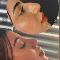 فرصت بینظیر جراحی بینی در تهران