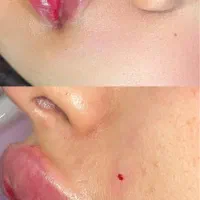 تزریق ژل لب و مادلینگ کامل صورت ب روش روسی وعربی
