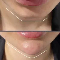 تخصص حرفه ای تزریق لب روسی