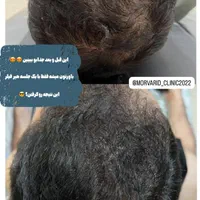تزریق ژل بوتاکس لیزر فیلر فیشال پاک کردن تاتو|خدمات آرایشگری و زیبایی|قدس, شهر‌قدس|دیوار