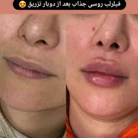 بوتاکس ژل آنزیم نخ لاغری بوتاکس 650 ژل اودری 450|خدمات آرایشگری و زیبایی|قم, هفت تیر|دیوار