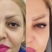 لیفت شقیقه وگونه با جراحی|خدمات آرایشگری و زیبایی|بوکان, |دیوار