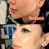 تزریق انواع بوتاکس  ژل آنزیم بینی نخ جوانسازی