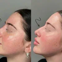 تزریق چربی فیلر کانتورینگ بوتاکس نخ لیفت مزوتراپی|خدمات آرایشگری و زیبایی|اصفهان, بوستان آینه خانه|دیوار
