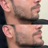 تزریق بوتاکس فیلر انزیم prp مزوتراپی جوانسازی|خدمات آرایشگری و زیبایی|کرمانشاه, |دیوار