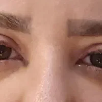 بلفاروپلاستی توسط متخصص چشم
