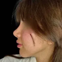 ماموپلاستی عمل بینی لیپو ابدو