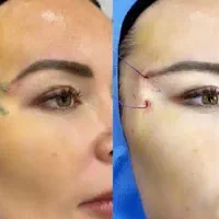 چند مدل نخ مونو و لیفت با نخ و ژل لب و زاویه سازی