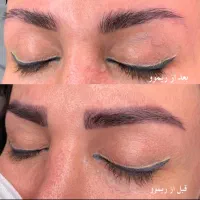 پاک کردن تتو با لیزر آمریکایی