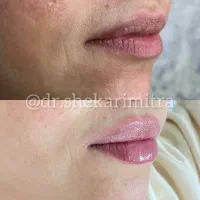 تزریقات زیبایی و خدمات درمانی|خدمات آرایشگری و زیبایی|کرج, دانشگاه آزاد|دیوار