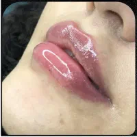 بوتاکس۵۹۰ فیلر۷۹۰لیزر فول بادی۷۵۰|خدمات آرایشگری و زیبایی|کیش, |دیوار