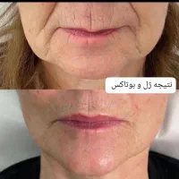 فیلر بوتاکس لیزر فیلربادی لاغری مزوتراپی prp جراحی|خدمات آرایشگری و زیبایی|مشهد, هنرستان|دیوار