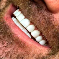 کامپوزیت دندان/جشنواره تخفیف