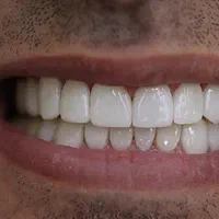 دندانپزشکی.کامپوزیت.روکش دندان.لمینت.ترمیم|خدمات آرایشگری و زیبایی|کرمانشاه, |دیوار