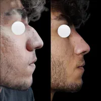 اصلاح قوزوافتادگی بینی بدون جراحی در مطب( تضمینی)|خدمات آرایشگری و زیبایی|شاهینشهر, فردوسی|دیوار