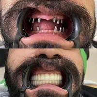 ایمپلنت دیجیتال دندان اوردنچر کاشت از دم اقساط|خدمات آرایشگری و زیبایی|تهران, قیطریه|دیوار