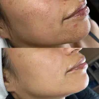 فشیال ،میکرونیدیلینگ صورت بانوان