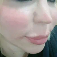 تزریق ژل و بوتاکس