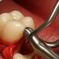جراحی دندان عقل،۲۰ درصد تخفیف،پنج شنبه های دونفره