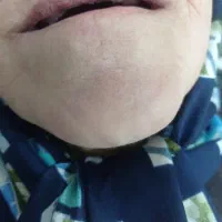 دندان مصنوعی لمینتی طرح لبخند