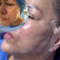 لیفت شقیقه و صورت|خدمات آرایشگری و زیبایی|اهواز, کیان اباد|دیوار