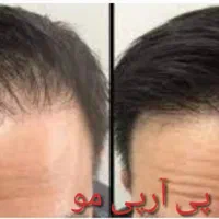 پی آر پی، بوتاکس ،ژل ،مزو، لیزر مو