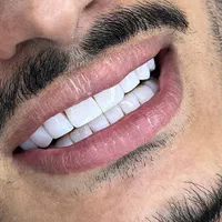 ایمپلنت اوردنچر کامپوزیت دندان روکش دندان لمینت|خدمات آرایشگری و زیبایی|تهران, ستارخان|دیوار