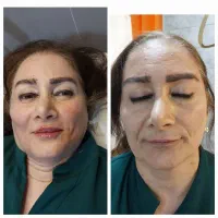 اموزش تزریقات زیبایی بوتاکس و فیلر و مزو|خدمات آموزشی|ارومیه, |دیوار