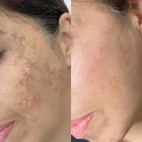 پاک کردن ننو ریر نظر پزشک