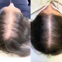 لابیاپلاستی اگروزوم prpبوتاکس مدل برای فیلر بیکینی|خدمات آرایشگری و زیبایی|مشهد, سرافرازان|دیوار