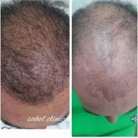 ژل بوتاکس پی آرپی لیفت مزوتراپی توسط پزشک در مطب|خدمات آرایشگری و زیبایی|اسلام‌شهر, باغ فیض|دیوار