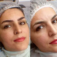 میکروبلیدینگ.فیبروز.رژلب دائم